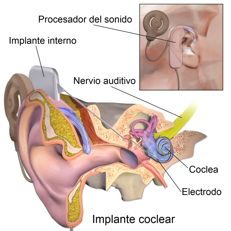 Implante coclear. Imagen: Bruce Blues en Wikimedia CC BY 3.0