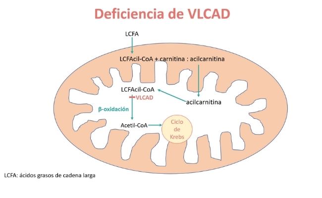 Deficiencia de VLCAD