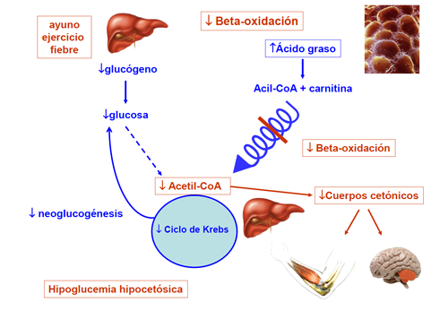 Hipoglucemia hipocetósica