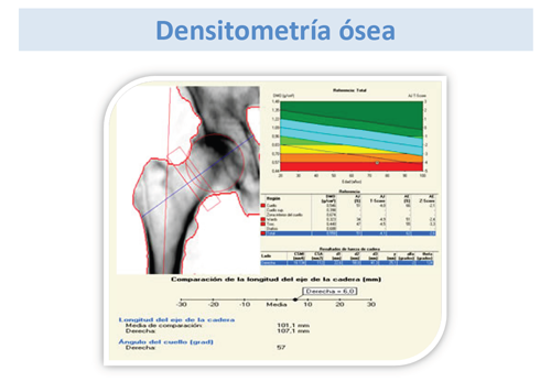 Densitometría ósea