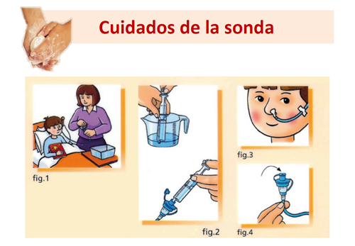 sonda nasogastrica en que casos se utiliza