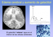 Edema cerebral y aumento e galactitol