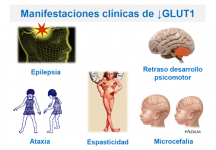 Manifestaciones clínicas de GLUT1
