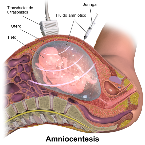 Amniocentesis, by Bruceblaus in wWkimedia