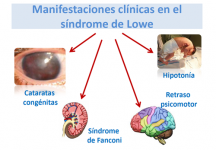Manifestaciones clínicas en el síndrome de Lowe