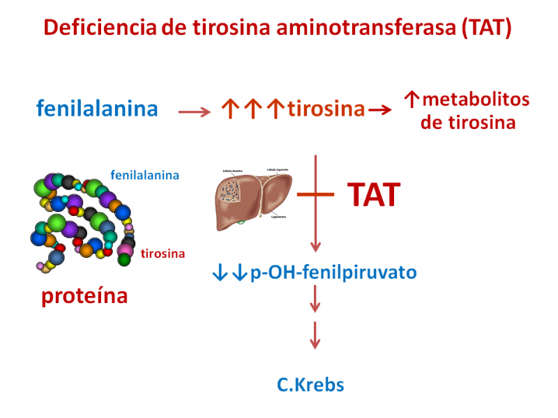 Deficiencia de tirosina aminotransferasa (TAT)