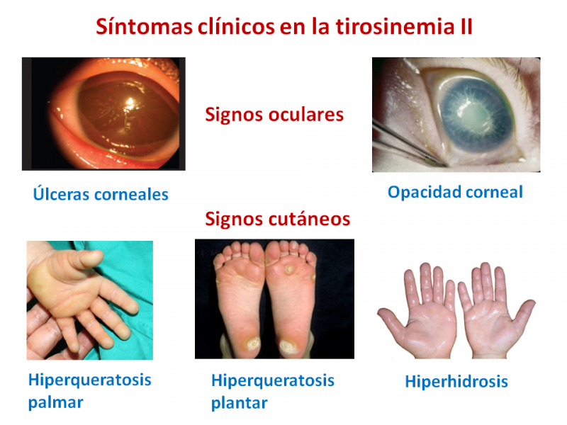  Síntomas de la tirosinemia tipo 2
