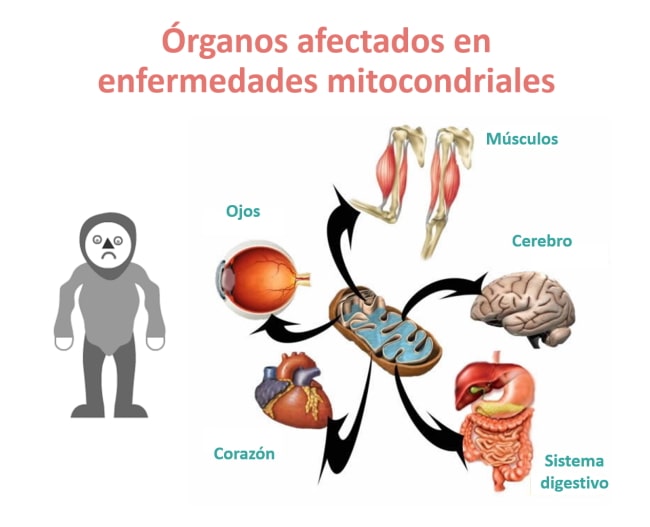 Órganos afectados en enfermedades mitocondriales
