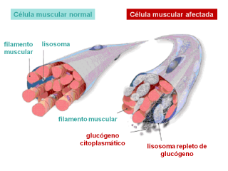 Célula muscular normal y célula afectada. Imagen: HSJDBCN