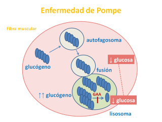 Acumulación de glucosa en el lisosoma. Imagen: HSJDBCN