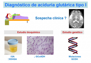 glutaric aciduria treatment        
        <figure class=