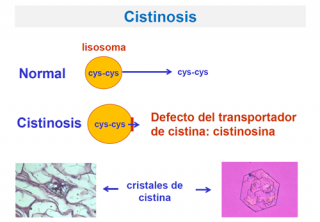 ¿Qué ocurre en la cistinosis?