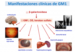 ¿Qué ocurre en el caso de un niño/a que nace con una gangliosidosis GM1?