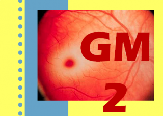 Gangliosidosis GM2. Imagen: HSJDBCN