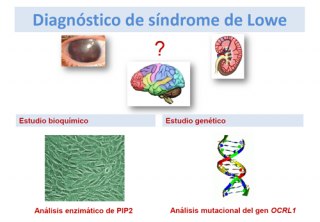 ¿Cómo se diagnostica el síndrome de Lowe?