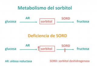 Deficiencia de sorbitol deshidrogenasa (SORD) en pacientes con una neuropatía motora hereditaria (enfermedad de Charcot-Marie-Tooth tipo 2)