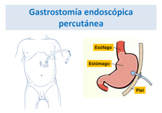  ¿Qué es una gastrostomía endoscópica percutánea? 