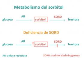 Deficiencia de sorbitol deshidrogenasa (SORD) en pacientes con una neuropatía motora hereditaria (enfermedad de Charcot-Marie-Tooth tipo 2)