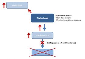 Galactosemia