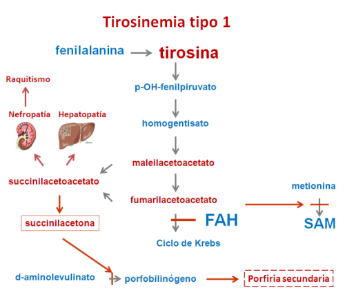 Tirosinemia tipo 1